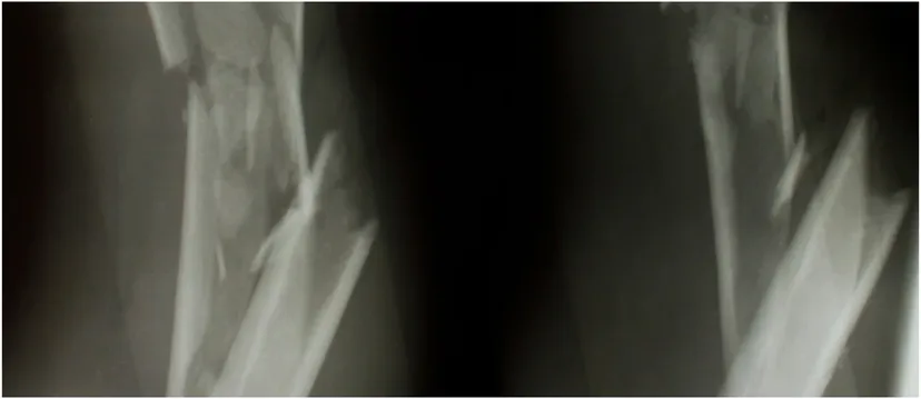 Radiographs of a comminuted long-bone diaphyseal fracture