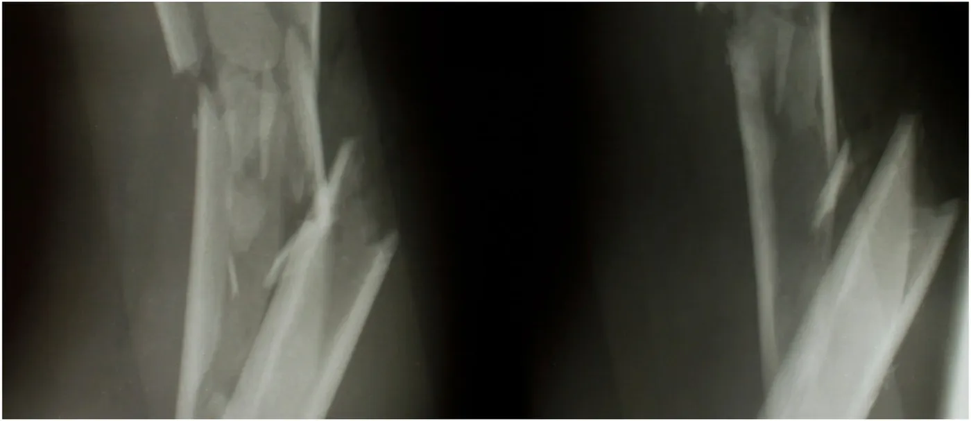 Radiographs of a comminuted long-bone diaphyseal fracture