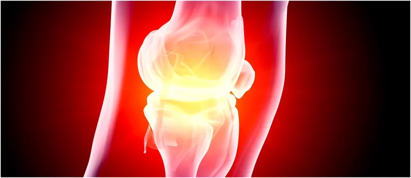 Illustration of an inflamed knee joint