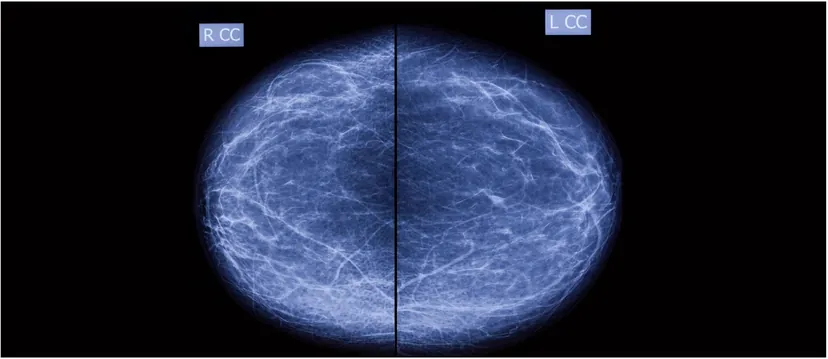 Bilateral craniocaudal screening mammogram