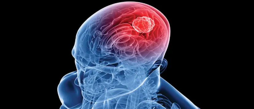 Illustration of a brain tumor within the head