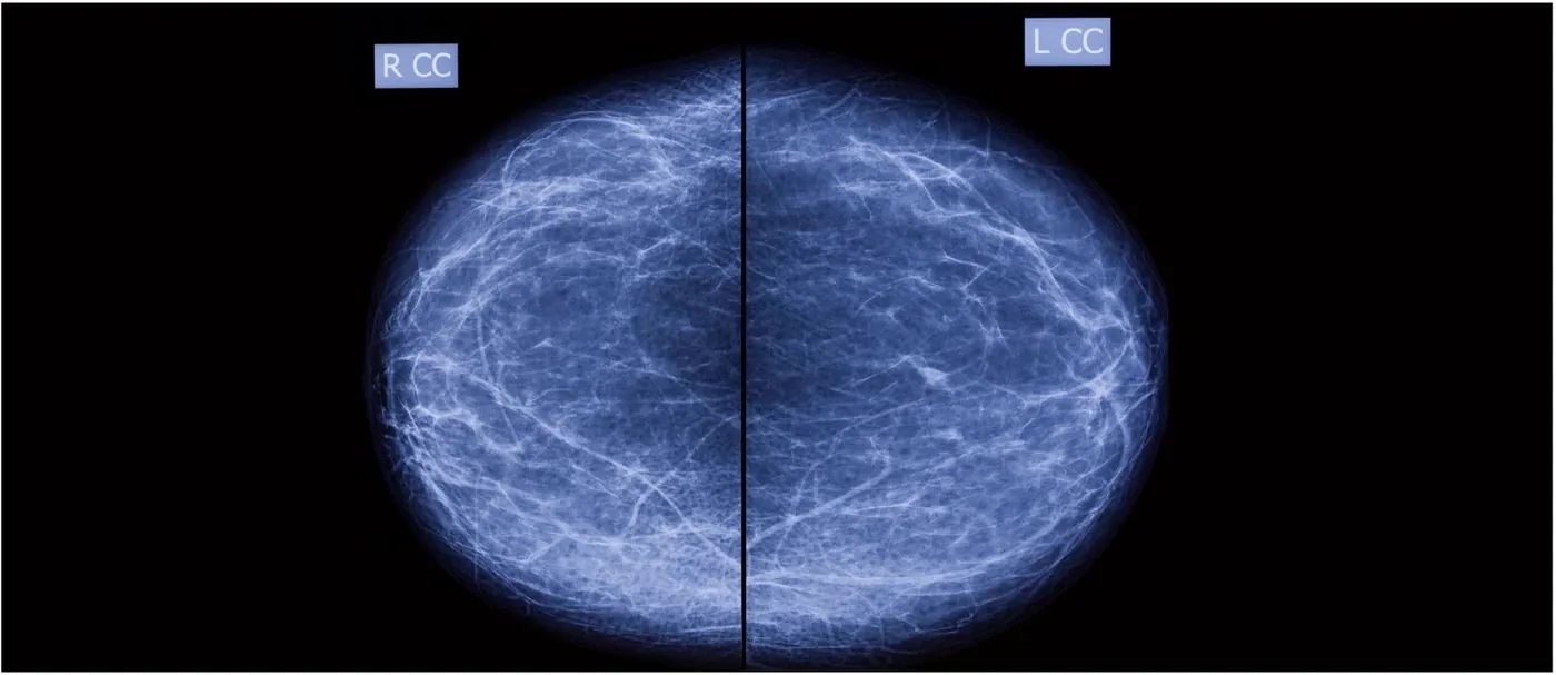 Bilateral craniocaudal screening mammogram