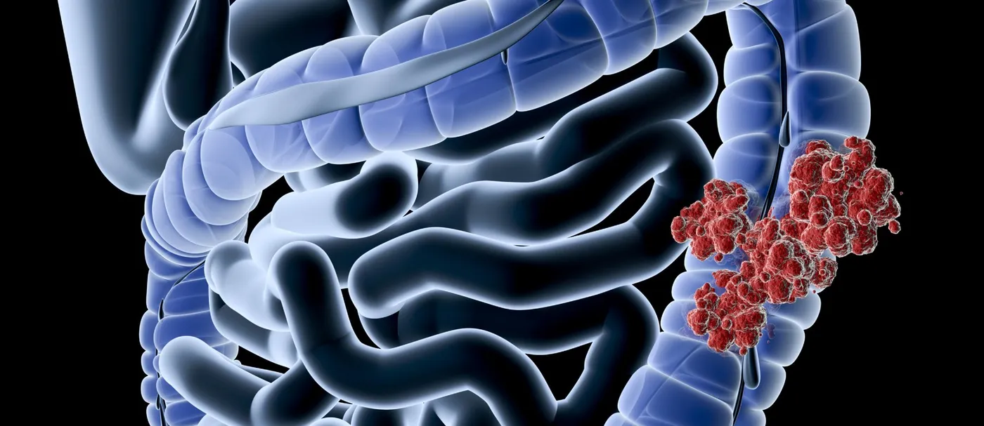 Illustration of the colon with a red tumor mass in the sigmoid region representing colorectal cancer