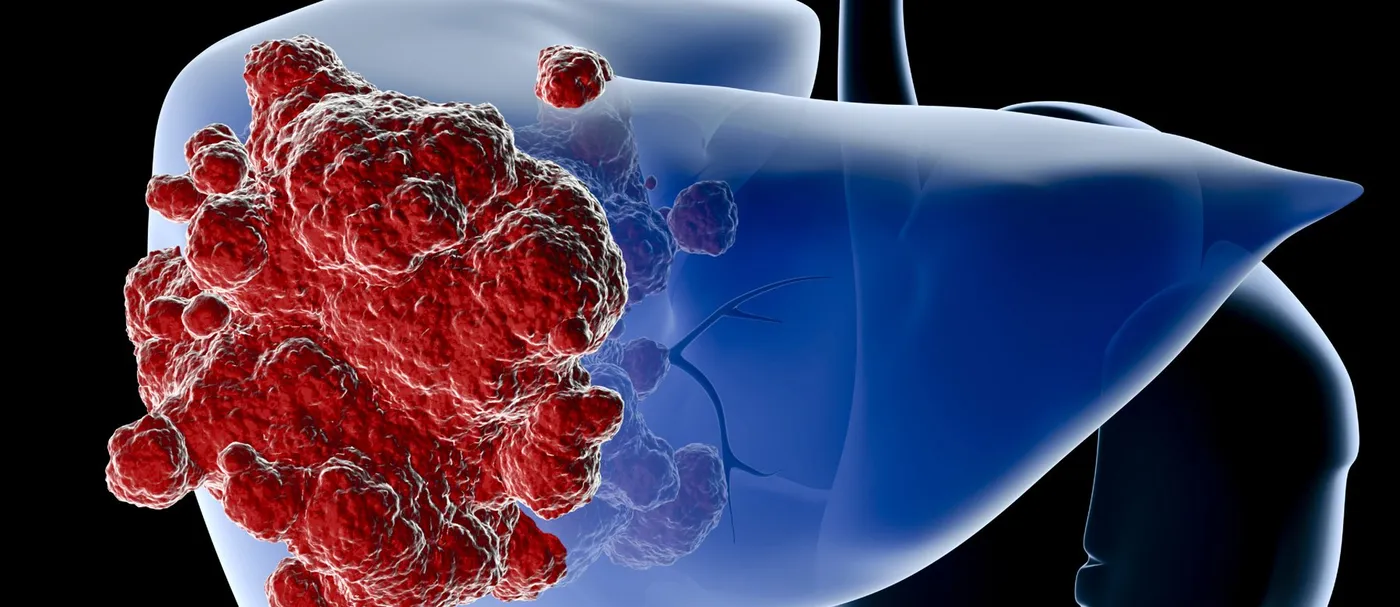 Illustration of a liver with a cluster of red tumor cells on its surface, representing imaging of tumor response