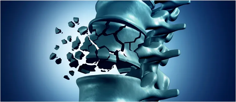 Illustration of a vertebral compression fracture